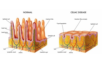 Propolis: Potential Solution to Gluten-induced Celiac Disease